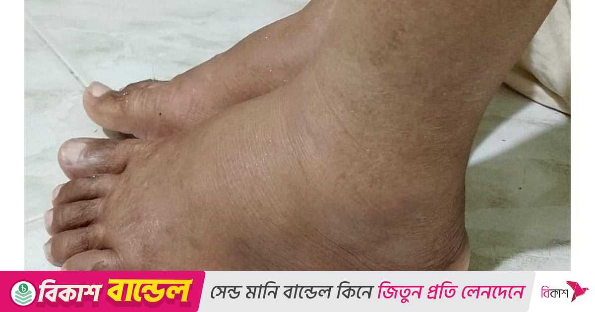 হঠাৎ পা কেন ফুলেছে?